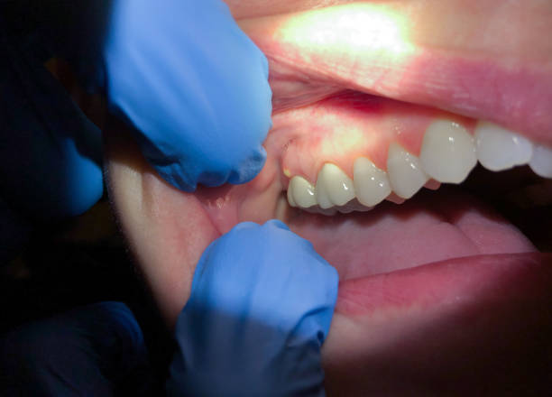 Best Emergency Denture Repair in Mason, OH