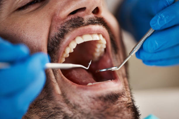 Best Urgent Care for Lost Fillings or Crowns in Mason, OH