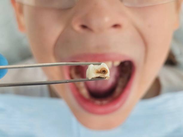 Best Emergency Root Canal Treatment in Mason, OH
