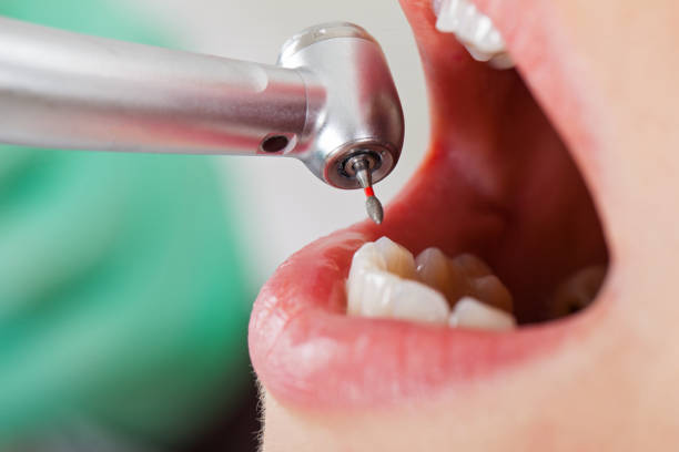 Best Emergency Tooth Extraction in Mason, OH